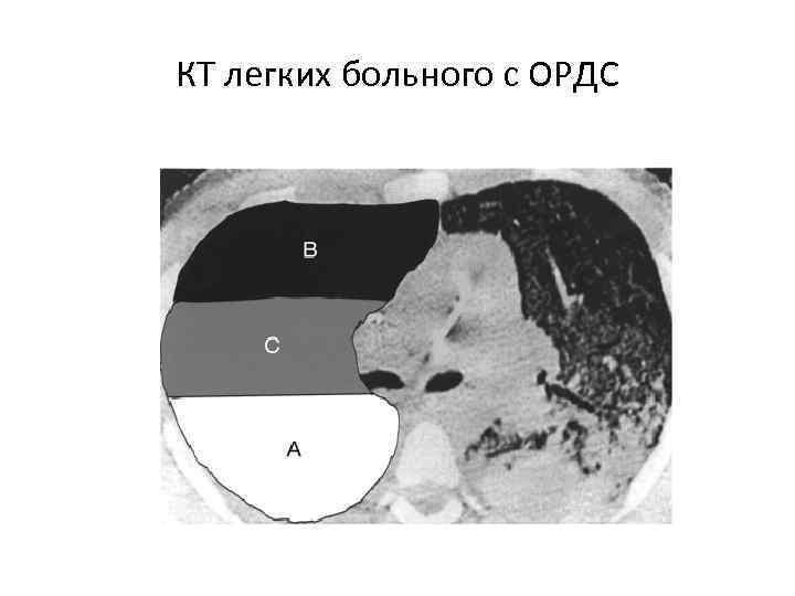 КТ легких больного с ОРДС 