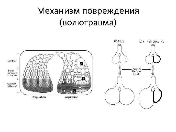 Механизм повреждения (волютравма) 