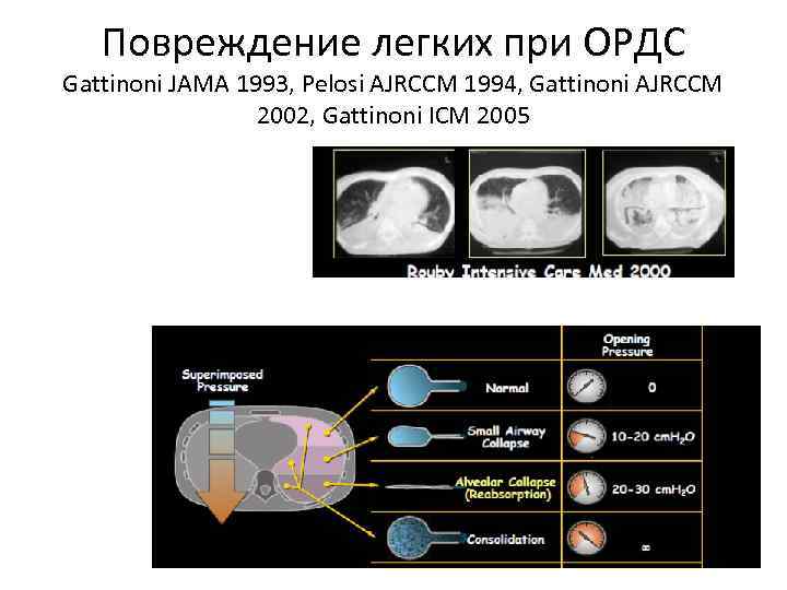 Повреждение легких при ОРДС Gattinoni JAMA 1993, Pelosi AJRCCM 1994, Gattinoni AJRCCM 2002, Gattinoni