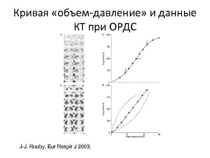 Кривая «объем-давление» и данные КТ при ОРДС J-J. Rouby, Eur Respir J 2003; 