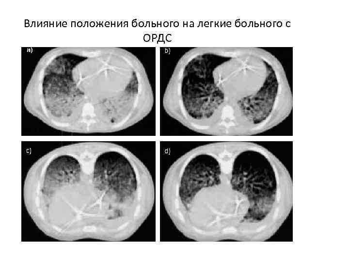 Влияние положения больного на легкие больного с ОРДС 