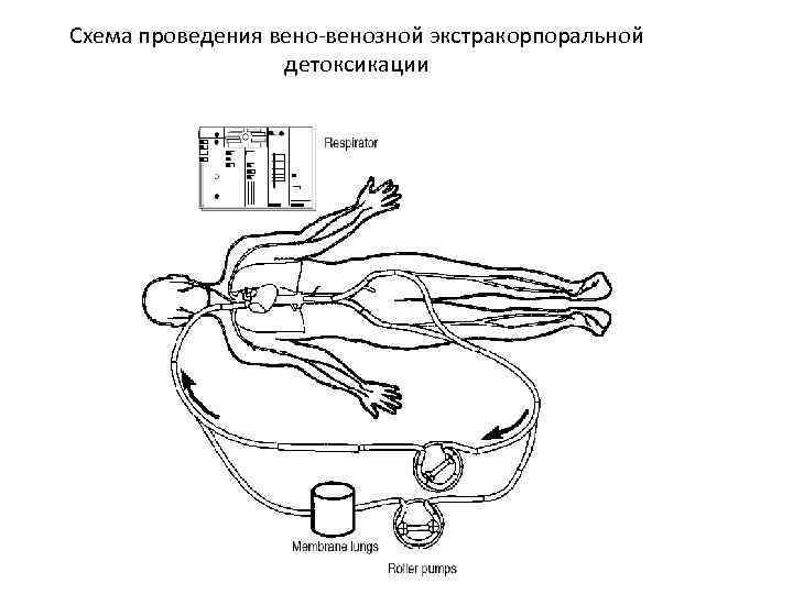 Схема проведения вено-венозной экстракорпоральной детоксикации 