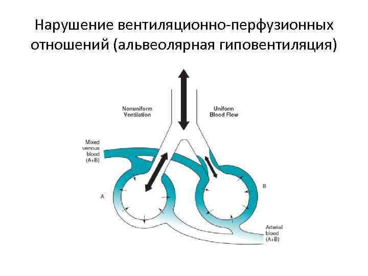 Нарушение вентиляционно-перфузионных отношений (альвеолярная гиповентиляция) 