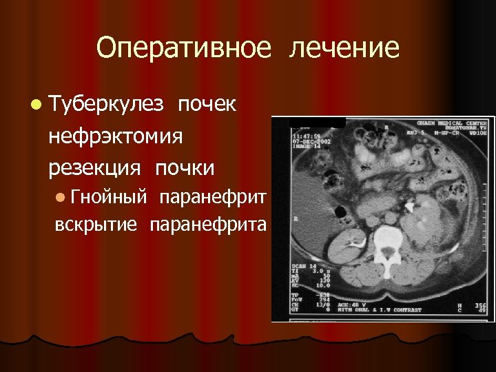 Оперативное лечение l Туберкулез почек нефрэктомия резекция почки l Гнойный паранефрит вскрытие паранефрита 