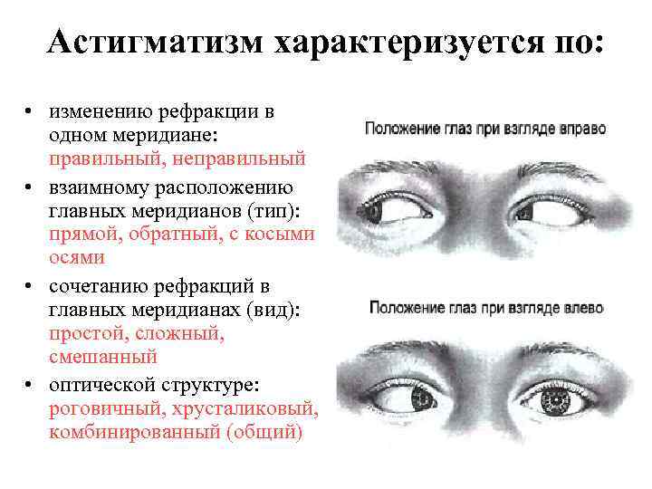 Астигматизм характеризуется по: • изменению рефракции в одном меридиане: правильный, неправильный • взаимному расположению