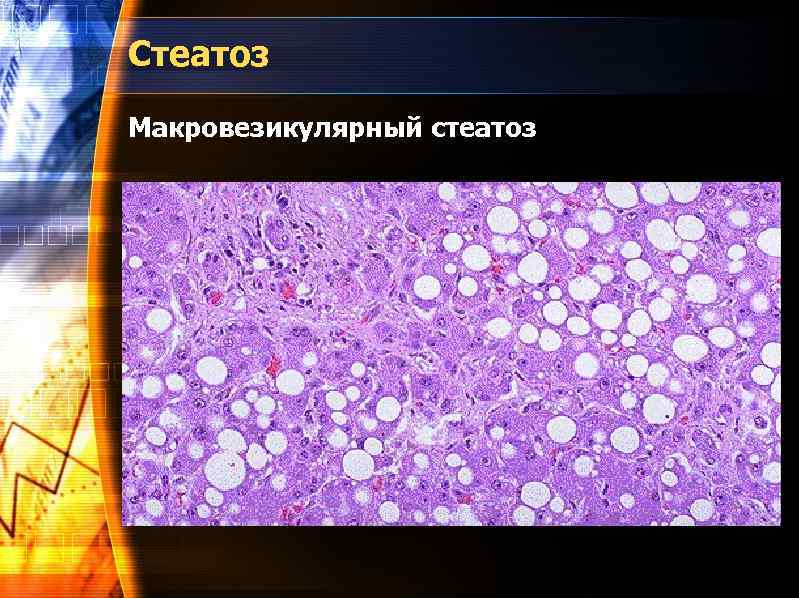 Стеатоз Макровезикулярный стеатоз 