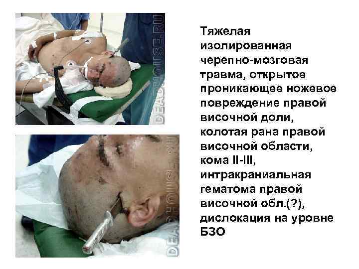 Тяжелая изолированная черепно-мозговая травма, открытое проникающее ножевое повреждение правой височной доли, колотая рана правой