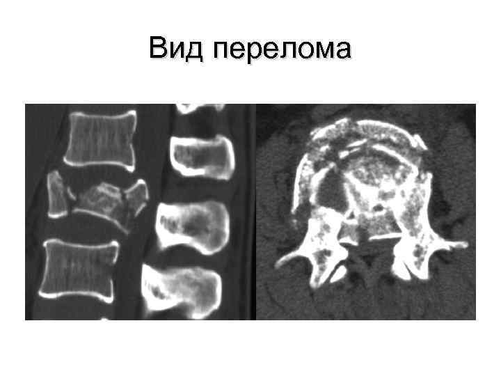 Вид перелома 