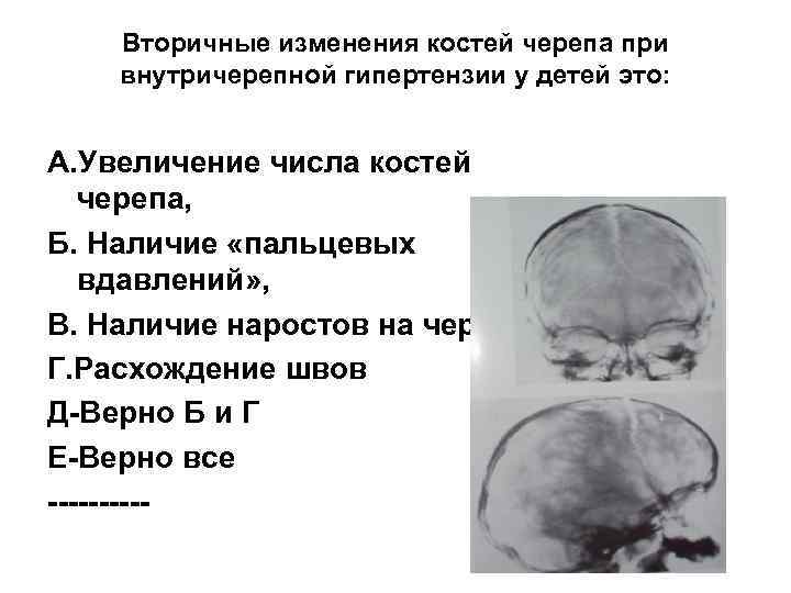 Усилен рисунок пальцевых вдавлений по всему своду черепа у ребенка