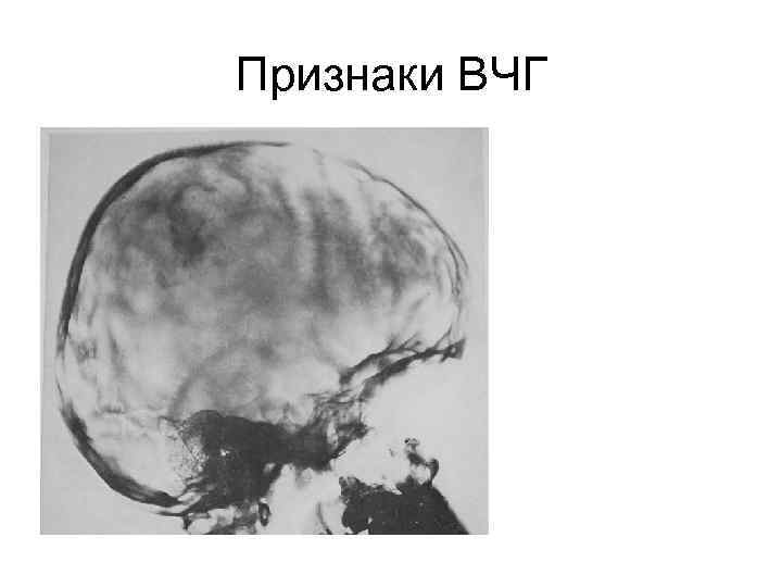 Признаки ВЧГ 