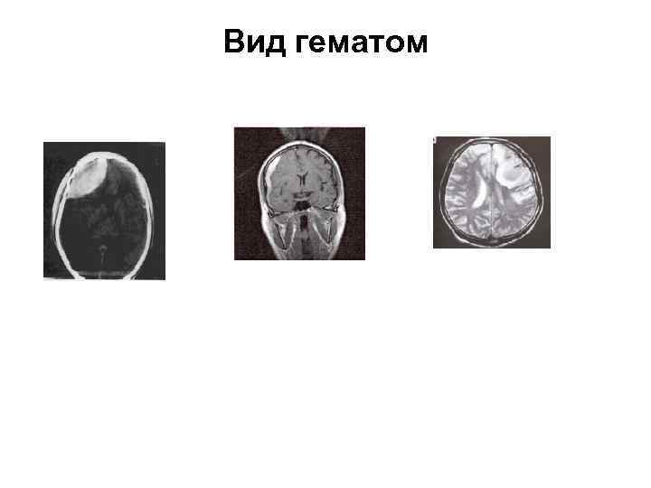 Вид гематом 