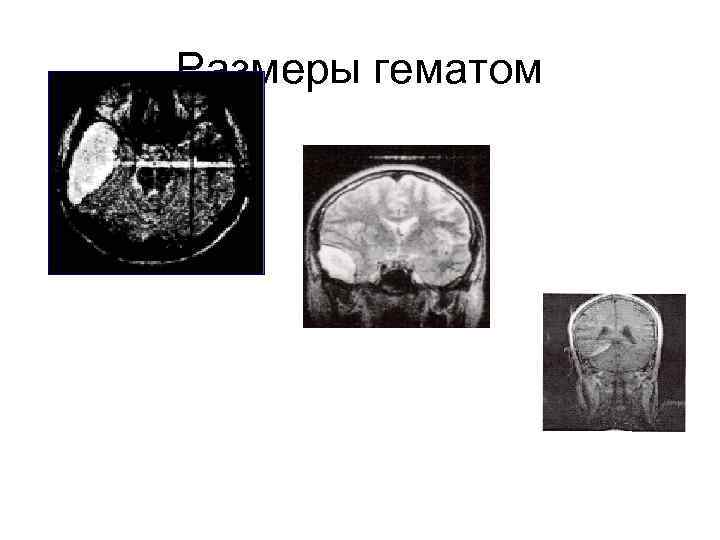 Размеры гематом 