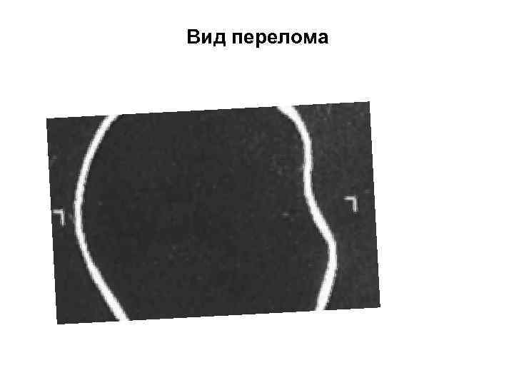Вид перелома 