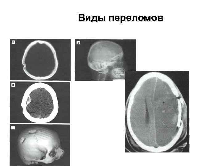 Виды переломов 