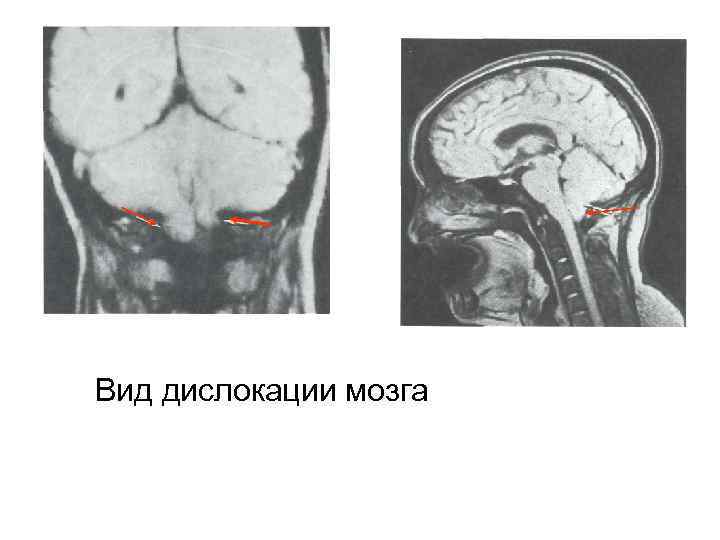 Вид дислокации мозга 