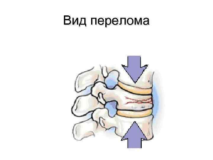 Вид перелома 