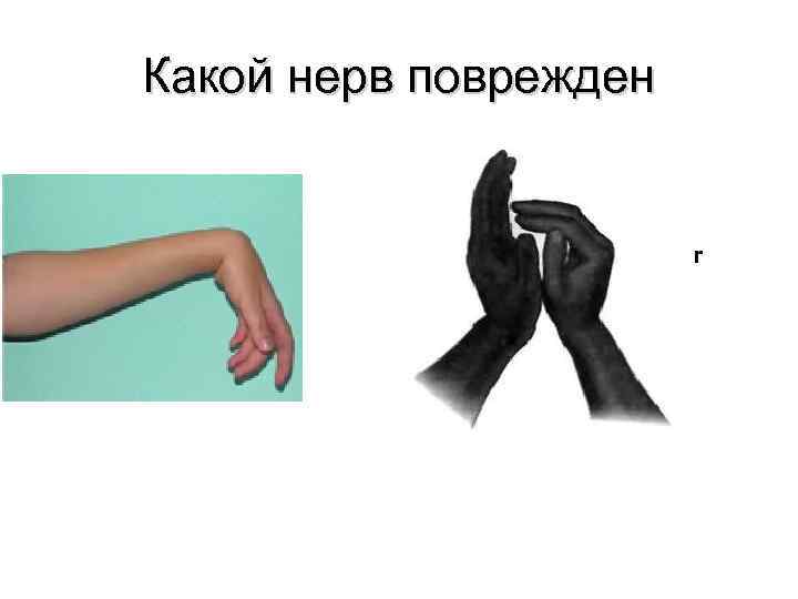 Какой нерв поврежден r 