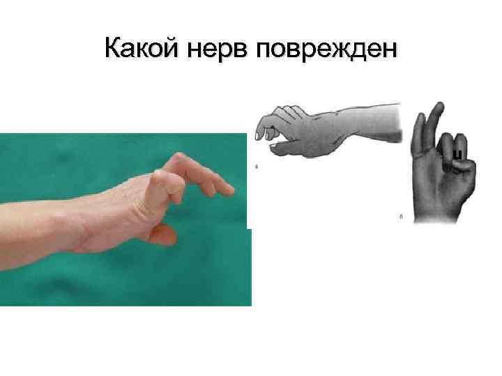 Какой нерв поврежден u 