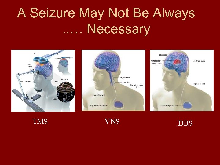 A Seizure May Not Be Always. . … Necessary TMS VNS DBS 