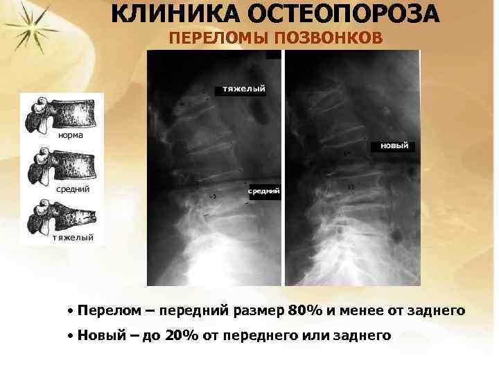 КЛИНИКА ОСТЕОПОРОЗА ПЕРЕЛОМЫ ПОЗВОНКОВ • Перелом – передний размер 80% и менее от заднего
