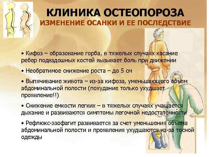 КЛИНИКА ОСТЕОПОРОЗА ИЗМЕНЕНИЕ ОСАНКИ И ЕЕ ПОСЛЕДСТВИЕ • Кифоз – образование горба, в тяжелых