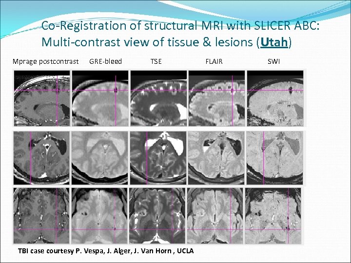 Co-Registration of structural MRI with SLICER ABC: Multi-contrast view of tissue & lesions (Utah)