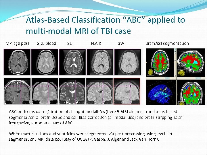 Atlas-Based Classification “ABC” applied to multi-modal MRI of TBI case MPrage post GRE-bleed TSE