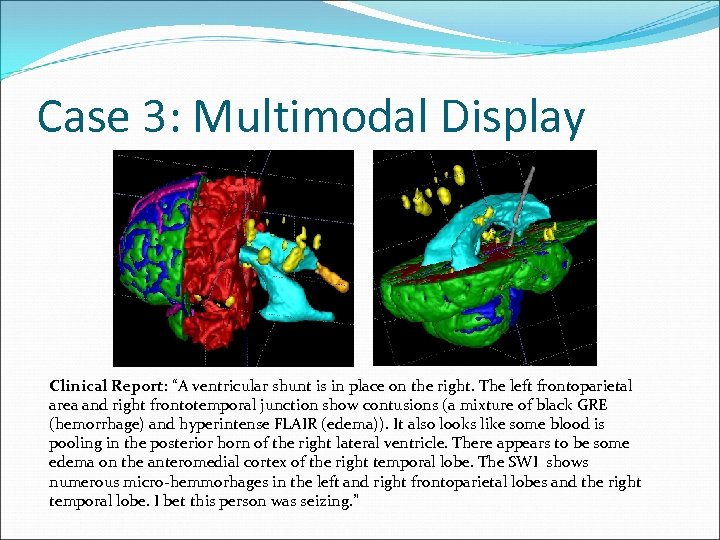Case 3: Multimodal Display Clinical Report: “A ventricular shunt is in place on the