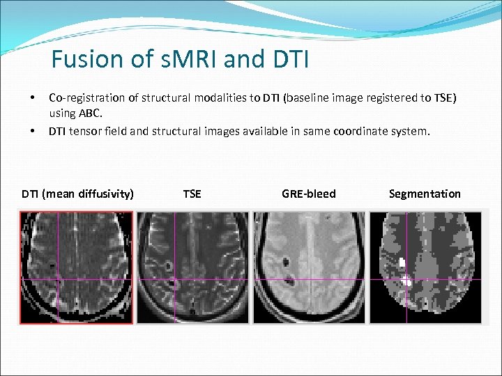 Fusion of s. MRI and DTI • • Co-registration of structural modalities to DTI