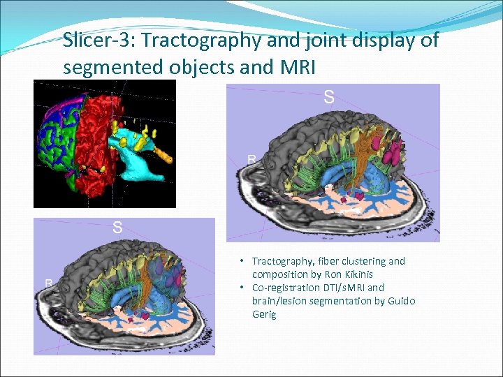 Slicer-3: Tractography and joint display of segmented objects and MRI • Tractography, fiber clustering