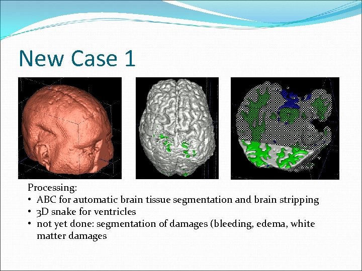 New Case 1 Processing: • ABC for automatic brain tissue segmentation and brain stripping