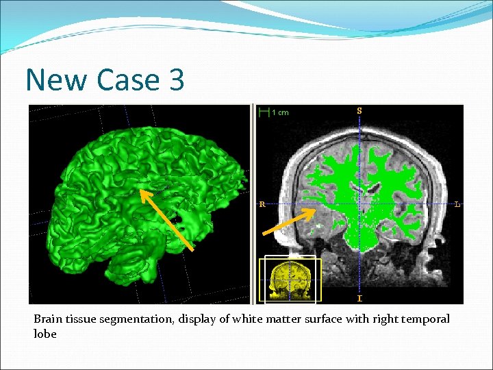 New Case 3 Brain tissue segmentation, display of white matter surface with right temporal
