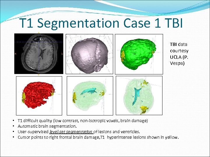 T 1 Segmentation Case 1 TBI data courtesy UCLA (P. Vespa) • • T