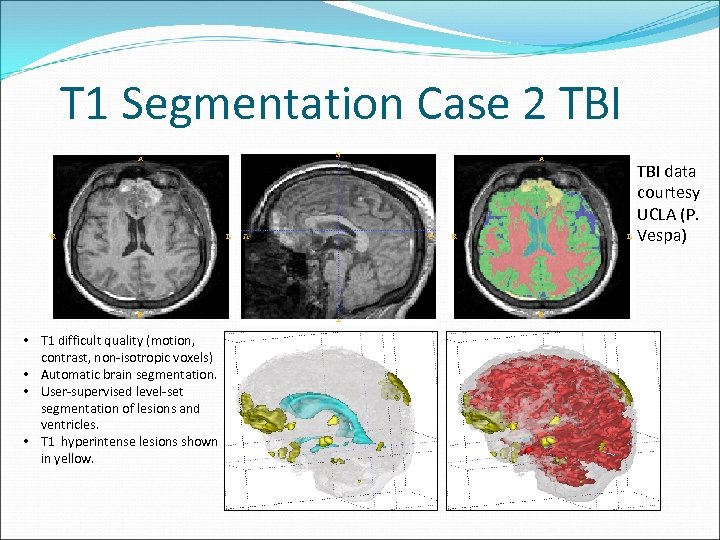 T 1 Segmentation Case 2 TBI data courtesy UCLA (P. Vespa) • T 1