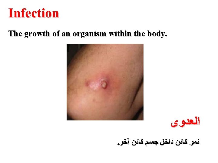 Infection The growth of an organism within the body. ﺍﻟﻌﺪﻭﻯ . ﻧﻤﻮ ﻛﺎﺋﻦ ﺩﺍﺧﻞ