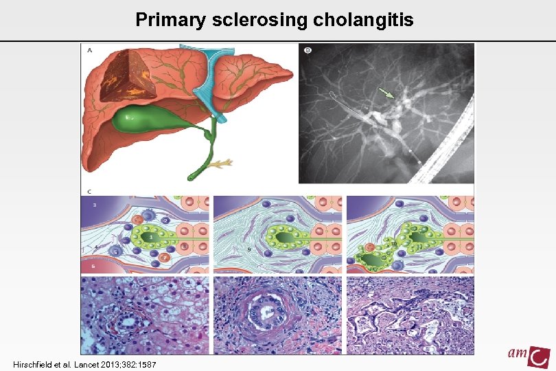 Primary sclerosing cholangitis Hirschfield et al. Lancet 2013; 382: 1587 