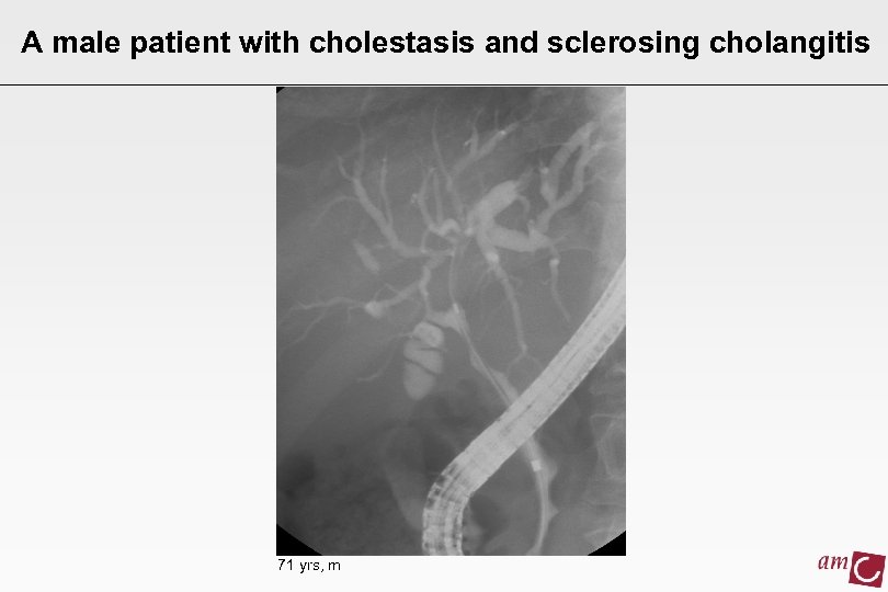 A male patient with cholestasis and sclerosing cholangitis 71 yrs, m 