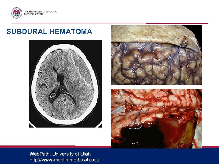 SUBDURAL HEMATOMA Web. Path: University of Utah http: //www-medlib. med. utah. edu 