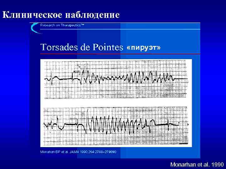 Клиническое наблюдение «пируэт» Monarhan et al. 1990 