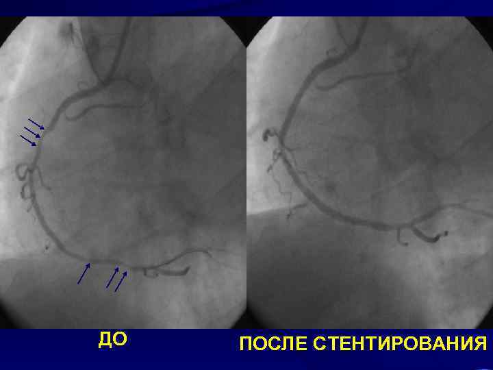 ДО ПОСЛЕ СТЕНТИРОВАНИЯ 