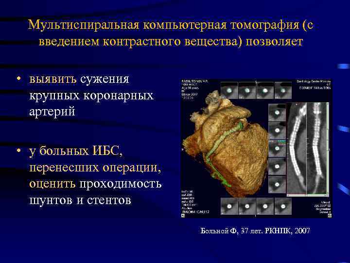 Мультиспиральная компьютерная томография (с введением контрастного вещества) позволяет • выявить сужения крупных коронарных артерий