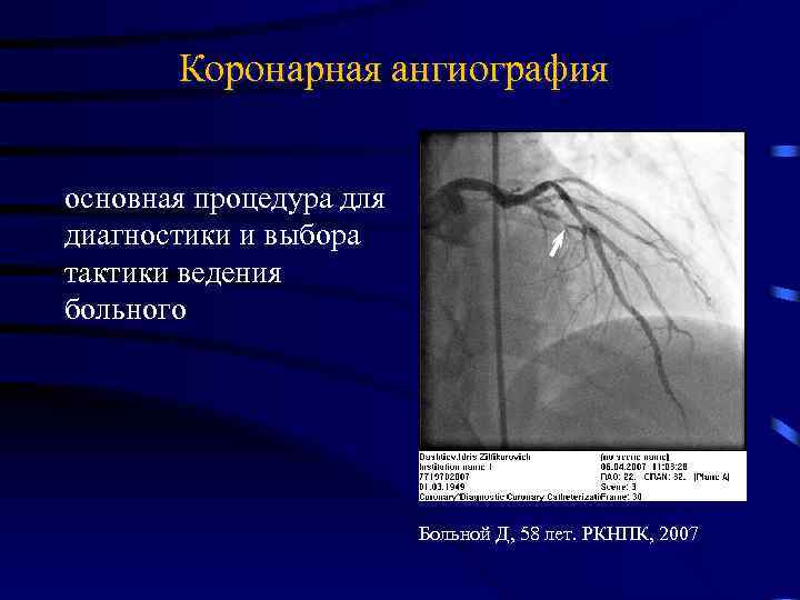 Коронарная ангиография основная процедура для диагностики и выбора тактики ведения больного Больной Д, 58