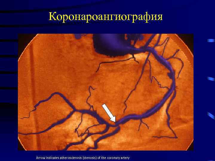 Коронароангиография 6 Arrow indicates atherosclerosis (stenosis) of the coronary artery 