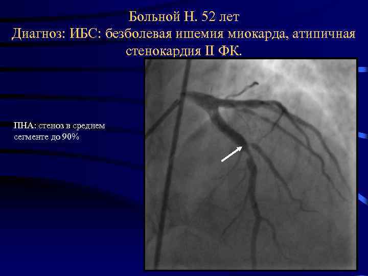 Больной Н. 52 лет Диагноз: ИБС: безболевая ишемия миокарда, атипичная стенокардия II ФК. ПНА: