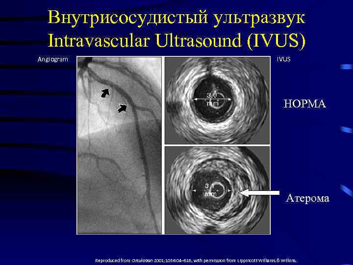 Внутрисосудистый ультразвук Intravascular Ultrasound (IVUS) Angiogram IVUS НОРМА Атерома Reproduced from Circulation 2001; 103: