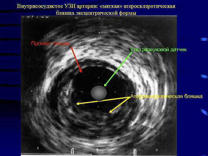 Внутрисосудистое УЗИ артерии: «мягкая» атеросклеротическая бляшка эксцентрической формы Просвет сосуда Ультразвуковой датчик Атеросклеротическая бляшка