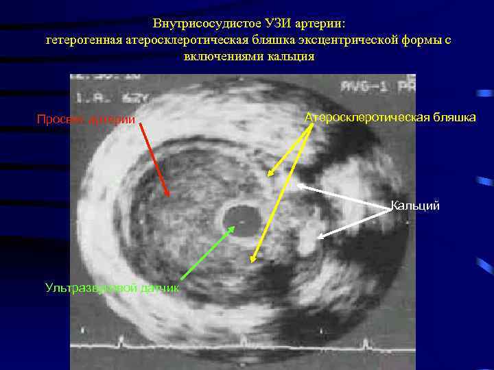 Внутрисосудистое УЗИ артерии: гетерогенная атеросклеротическая бляшка эксцентрической формы с включениями кальция Просвет артерии Атеросклеротическая
