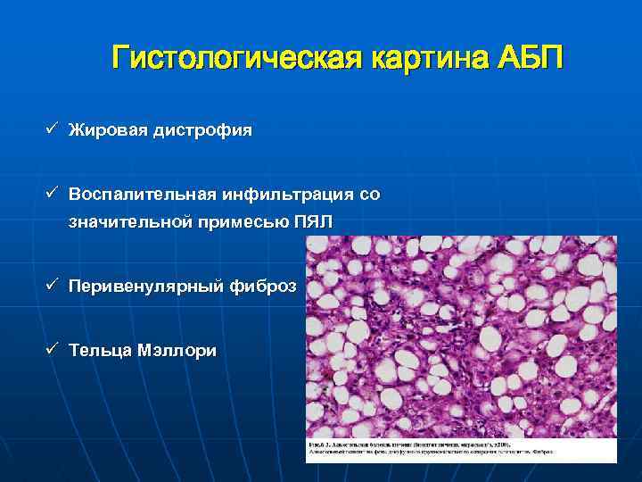 Алкогольная болезнь печени гистология. Жировой гепатоз печени гистология. Алкогольный гепатит гистология.