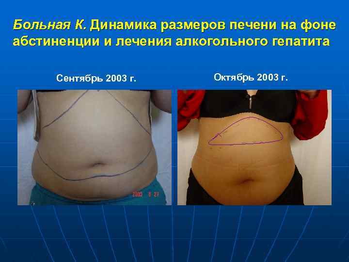 Больная К. Динамика размеров печени на фоне абстиненции и лечения алкогольного гепатита Сентябрь 2003