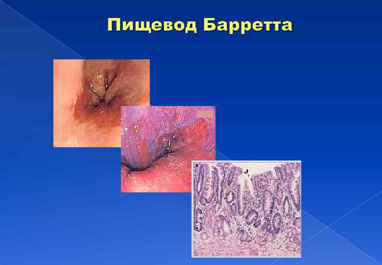 Пищевод Барретта 